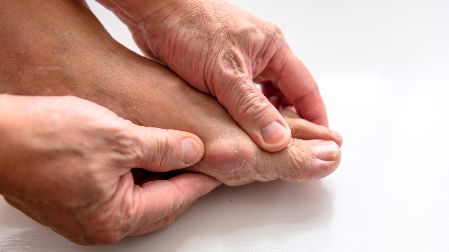Close-up of hands holding a swollen and inflamed big toe joint, illustrating gout in the foot.