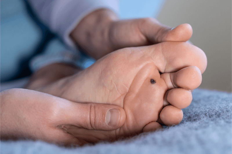 Bottom of a foot with a dark plantar wart on the base of the foot. Hand holding viewing it in relation to discussing the concerns of plantar warts.