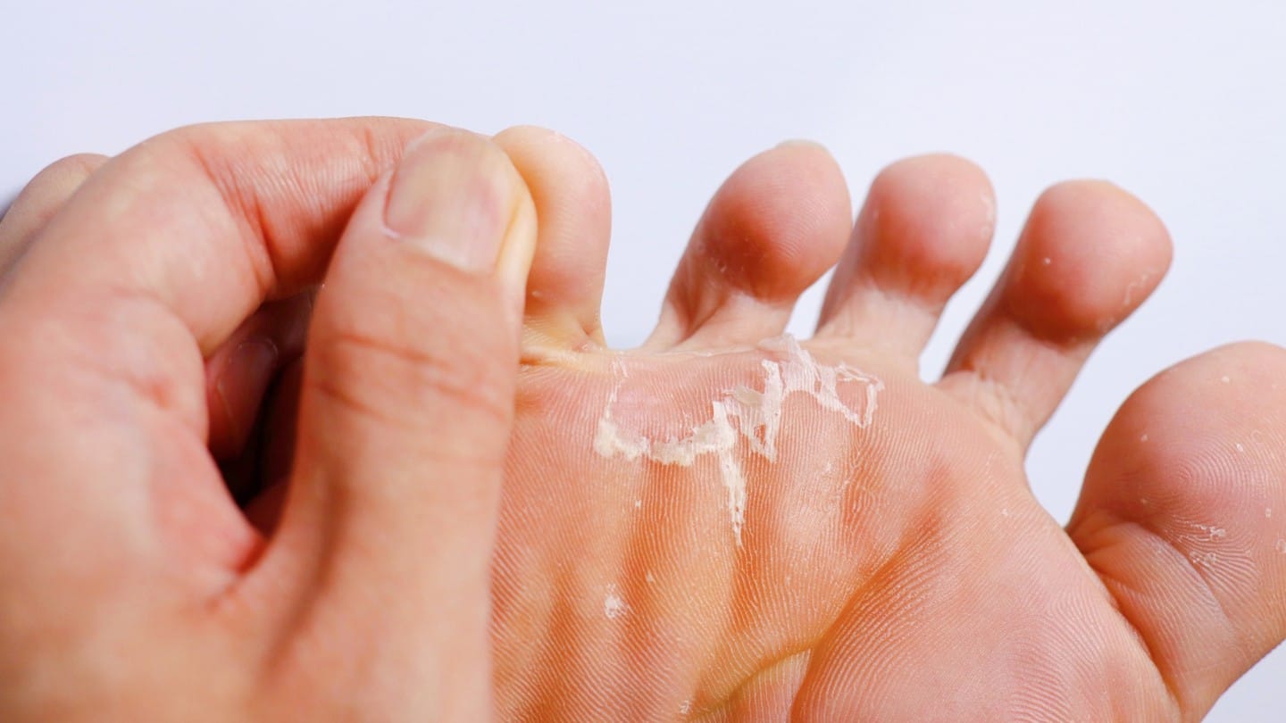 Person holding their foot with tinea in relation to athletes foot treatments at Hong Kong Foot Clinics
